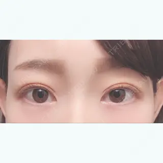 51日目の経過画像（1枚目）