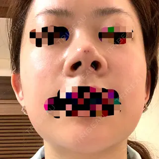 2日目の経過画像（3枚目）