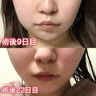 23日目の経過画像（1枚目）