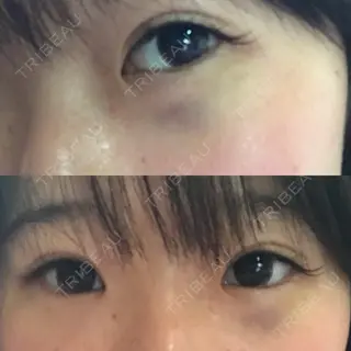 3日目の経過画像（1枚目）