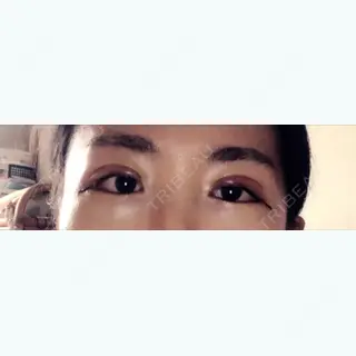 5日目の経過画像（1枚目）