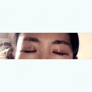 5日目の経過画像（2枚目）