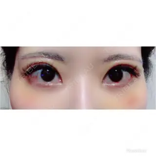 6日目の経過画像（2枚目）