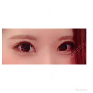 7日目の経過画像（3枚目）