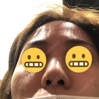0日目の経過画像（3枚目）