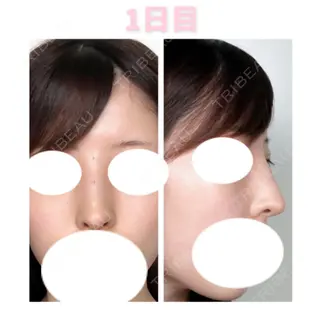 1日目の経過画像（1枚目）