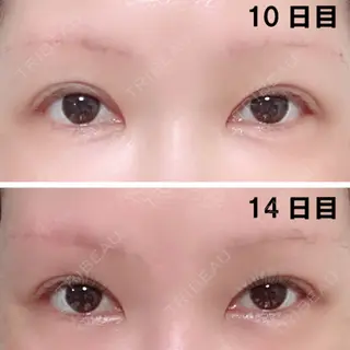 14日目の経過画像（1枚目）