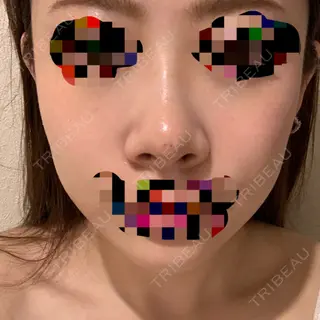 3日目の経過画像（1枚目）