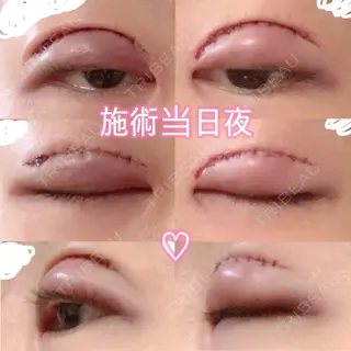 0日目の経過画像（1枚目）