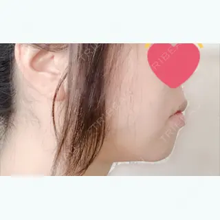 4日目の経過画像（2枚目）
