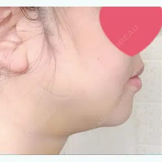 5日目の経過画像（3枚目）