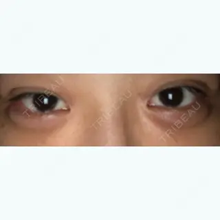 12日目の経過画像（1枚目）