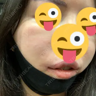0日目の経過画像（1枚目）