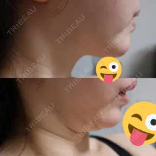 3日目の経過画像（2枚目）