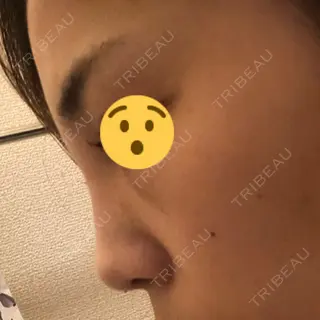 2日目の経過画像（3枚目）