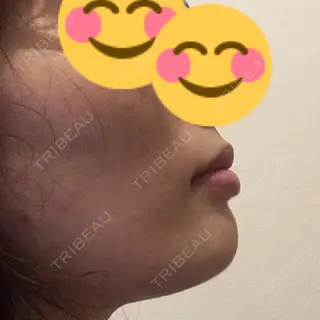 11日目の経過画像（3枚目）