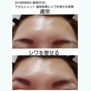 6日目の経過画像（1枚目）