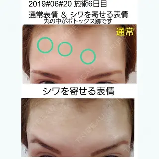 6日目の経過画像（1枚目）