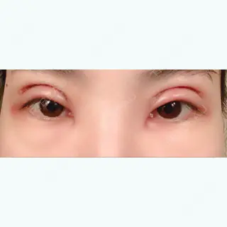2日目の経過画像（1枚目）