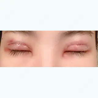 2日目の経過画像（2枚目）