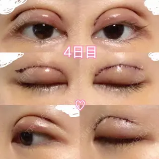 3日目の経過画像（1枚目）