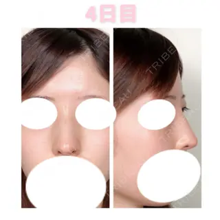4日目の経過画像（1枚目）