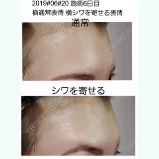 6日目の経過画像（1枚目）