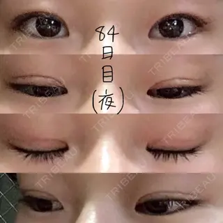 84日目の経過画像（1枚目）