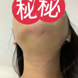 4日目の経過画像（3枚目）