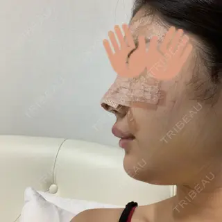 6日目の経過画像（2枚目）