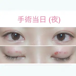 0日目の経過画像（2枚目）