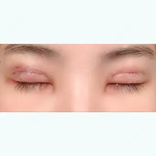 3日目の経過画像（2枚目）