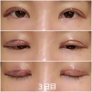 3日目の経過画像（1枚目）