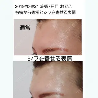 7日目の経過画像（1枚目）