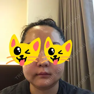 3日目の経過画像（2枚目）