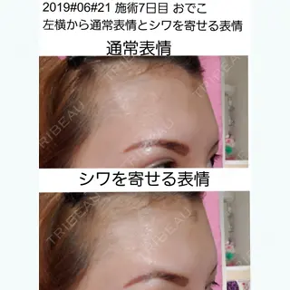7日目の経過画像（1枚目）