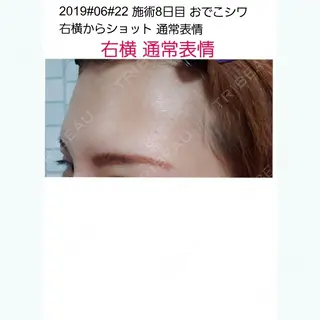 8日目の経過画像（1枚目）