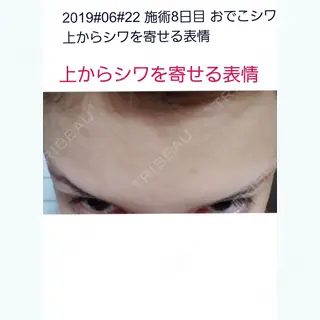 8日目の経過画像（1枚目）