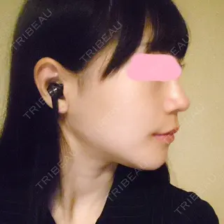 68日目の経過画像（3枚目）