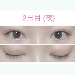2日目の経過画像（2枚目）