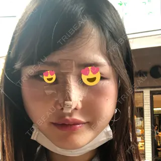 5日目の経過画像（1枚目）
