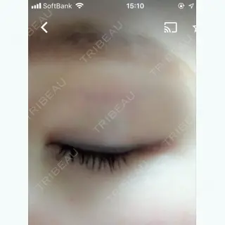 2日目の経過画像（3枚目）