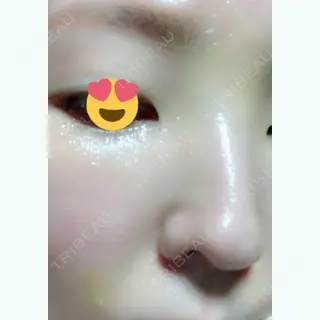 2日目の経過画像（2枚目）