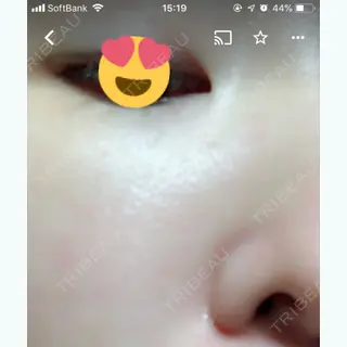 3日目の経過画像（2枚目）