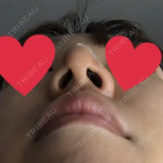 0日目の経過画像（2枚目）