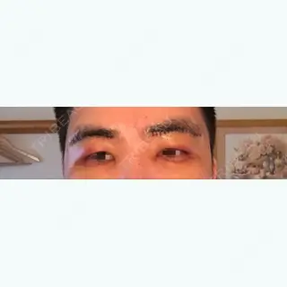 6日目の経過画像（1枚目）