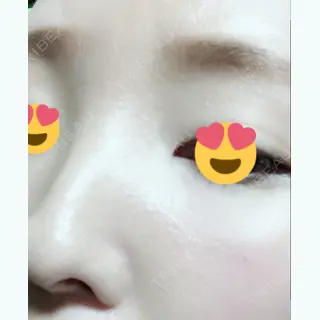 5日目の経過画像（3枚目）