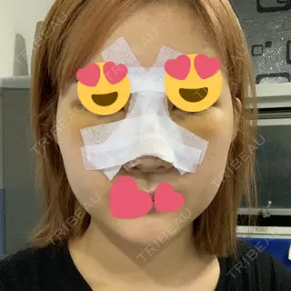 4日目の経過画像（1枚目）
