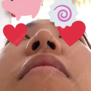 2日目の経過画像（2枚目）