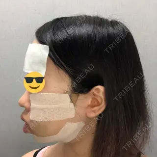 3日目の経過画像（3枚目）